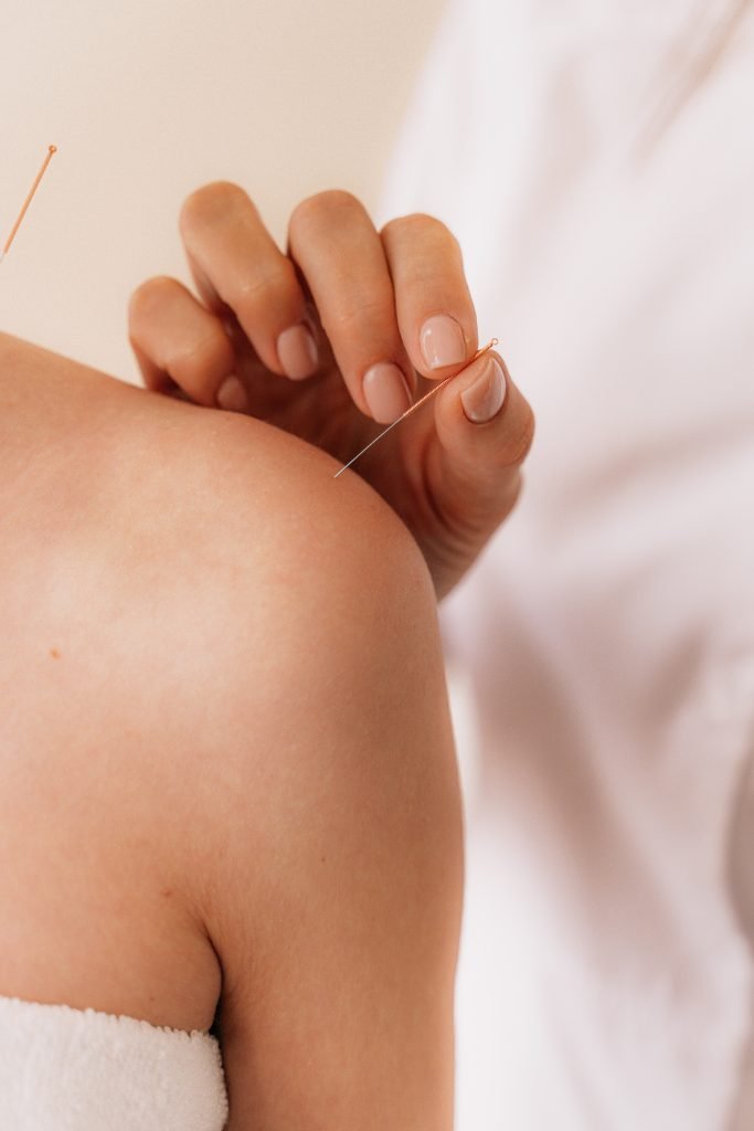Acupuncture acupuncture 2