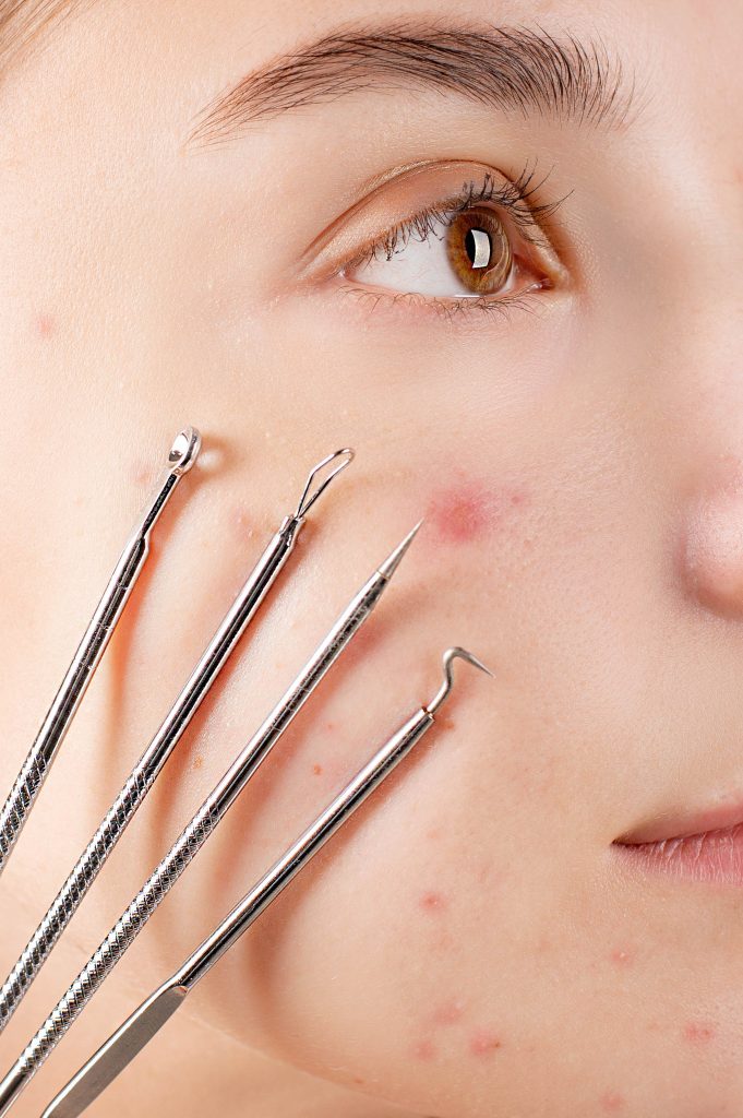 Lavender oil and acne: Exploring the potential benefits skincare